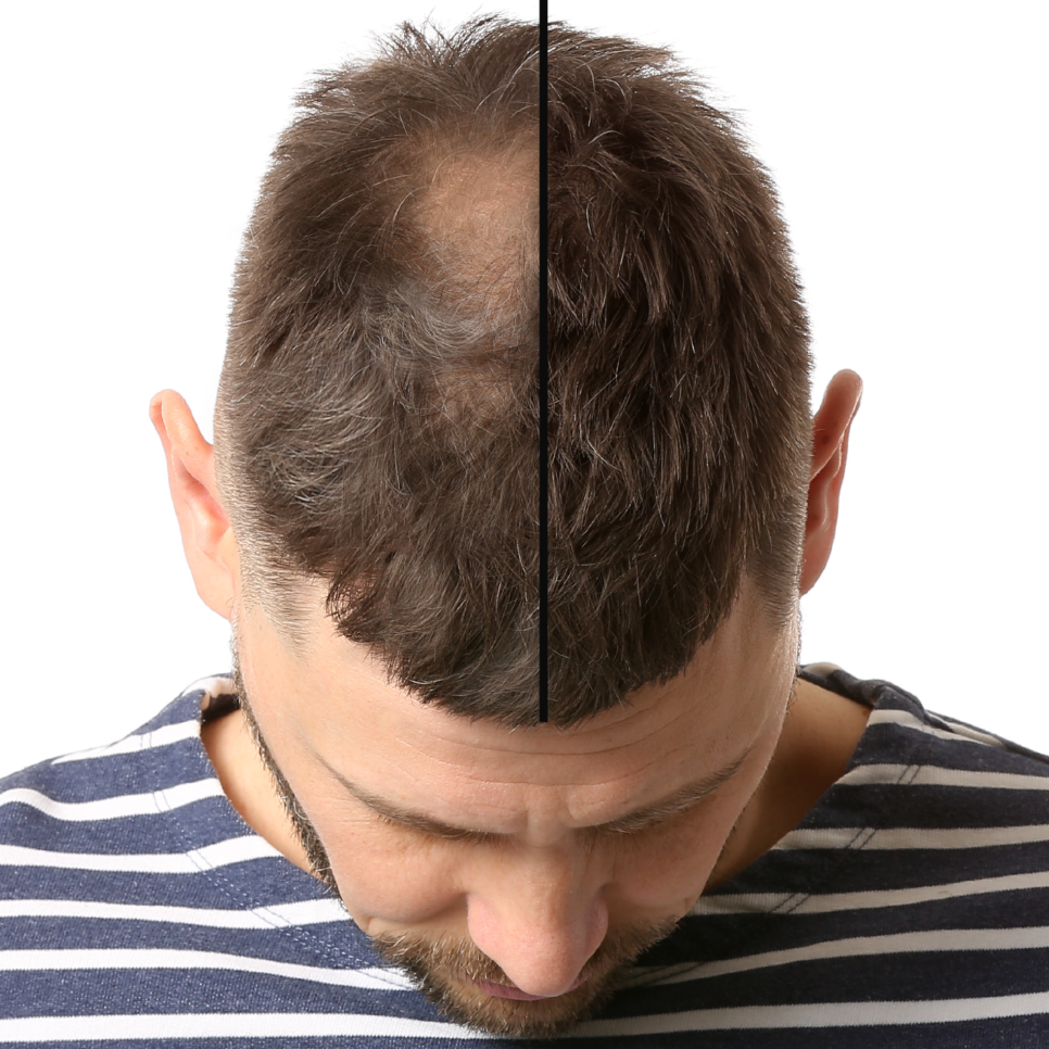 Capillus LaserCare 4 em 1 - Raiz ativa, fio forte.